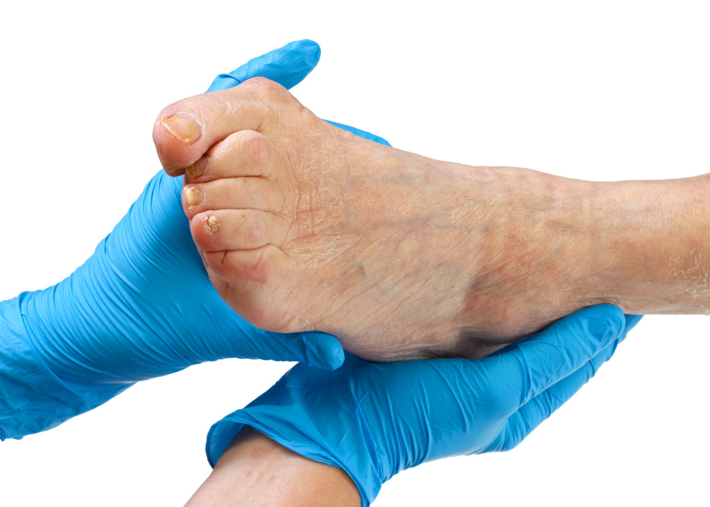 Hammer Toe Treatment (Crooked/Claw Toes) - Perth Foot Centre