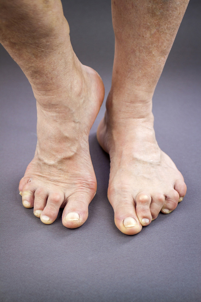 Hammer Toe Treatment (Crooked/Claw Toes) - Perth Foot Centre
